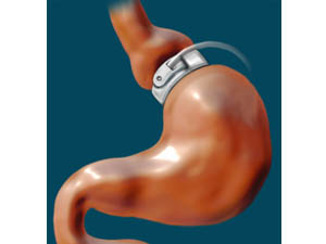 Types of Gastric Band
